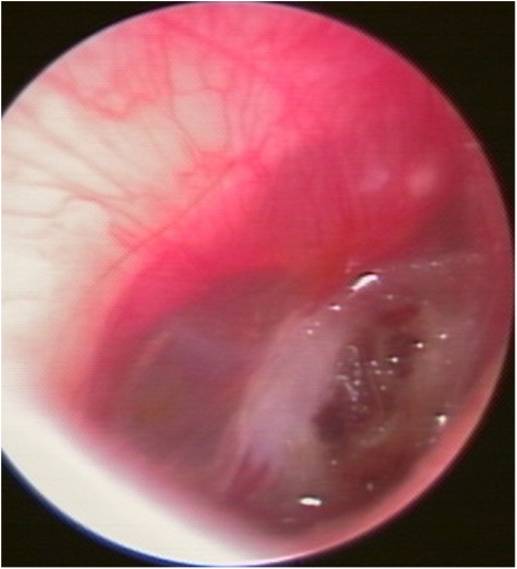 外伤性鼓膜穿孔