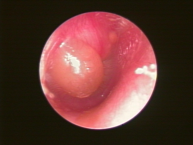 右急性中耳炎で鼓膜が腫脹し水疱形成が見られる