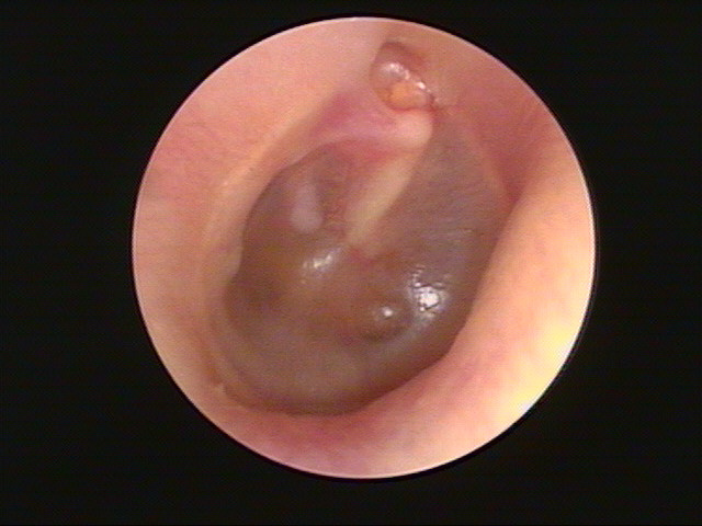 滲出性中耳炎の右鼓膜：貯留液が見られ鼓膜が陥凹してる
