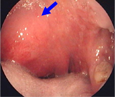 右扁桃周囲膿瘍